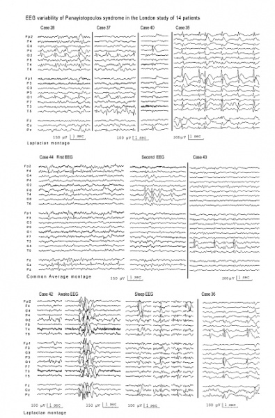 File:Illustrative samples of EEG from 14 children with Panayiotopoulos syndrome.jpg